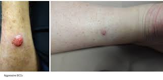 14,15 the incidence of bowen disease (squamous cell carcinoma in situ) peaks in the seventh decade and has a propensity for the lower legs, especially in women. Skin Lesions North Queensland Skin Centre