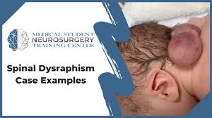 Image result for Spinal Dysraphism