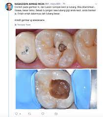 Sakit gigi adalah penyakit yang sangat menyiksa. Gigi Kerap Sakit Berlubang Doktor Jelaskan Puncanya