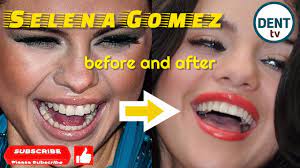 Selena gomez fake teeth