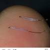 The most common cause of diffuse thinning is telogen effluvium (te). 1