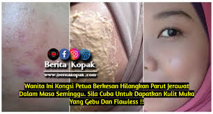 Saya sarankan amik asam jawa then ramas.jangan lupa.campur sedikit air.ulang sedikit air.sbb kalau bnyk sangat air kang dia cair sangat.pas2 sapukan asam jawa. Wanita Ini Kongsi Petua Berkesan Hilangkan P4rut Jeraw4t Dalam Masa Seminggu Sila Cuba Untuk Dapatkan Muka Flawless Berita Kopak