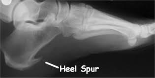 They didnt know what the problem was. Heel Spur