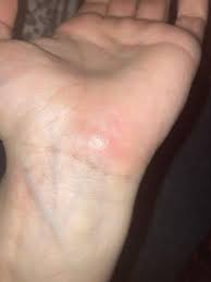 Image result for spinne biss haut reaktion