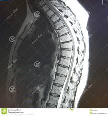 Mri Thoracic Spine Pathology Basis Modern Medicine Modern Diagnostic Possibilities To Show Area Different