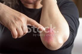 Os sintomas de psoríase nos cotovelos. Psoriase Em Cotovelo Fotos Do Acervo Freeimages Com
