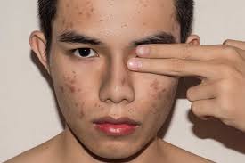 Maraso 30g scar acnes stretch gel cream marks keloid skin burns removal repairs. 10 Best Acne Scar Removal Creams For Indian Men Mensopedia