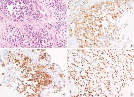 Check spelling or type a new query. The Histologic And Immunohistochemical Features Of Malignant Download Scientific Diagram