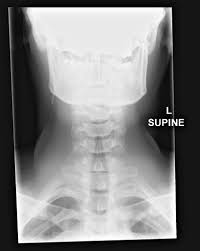 Fractured Ventriculoperitoneal Shunt With Resultant Hydrocephalus Radiology Case Radiopaedia Org Radiology Fracture Case