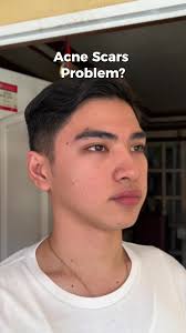 Get Rid of Acne Marks with Willis Airlift Treatment