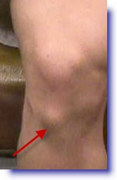 Knee Pain Part 3 Osgood Schlatters Disease Alexandra Sports