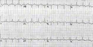 New onset congestive heart failure. Myocarditis Electrocardiogram Wikidoc
