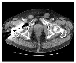 ct scan for mesothelioma a ct scan generates detailed three dimensional images of specific regions of the body. Unusual Radiologic Presentations Of Malignant Peritoneal Mesothelioma
