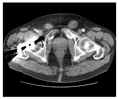 Unusual Radiologic Presentations Of Malignant Peritoneal Mesothelioma