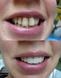 The biggest difference is that snap on make sure you clean the surface that comes into contact with your own teeth. Dental Veneers In Hungary Porcelain Veneers In Budapest
