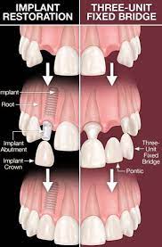 What is the cheapest dental implant? Dental Implant Cost In Gurgaon India 2021 Update Dantkriti Dental Clinic