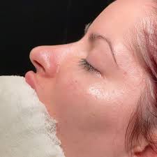 RinoBarbie 🌸 , En este tipo de nariz con punta hiperproyectada logramos  definición a pesar de la desproyección y piel gruesa. , #barbienose  #rinoplastia