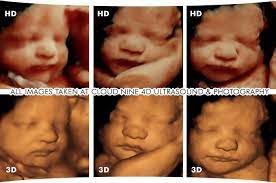 3d Ultrasound 4d Ultrasound Hd Ultrasound Chattanooga Tn