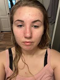 I'm looking for some help… I'm almost sure my acne is from hormones, I  haven't had it this bad since middle school. I wash my face every night  with salicylic acid, moisturize