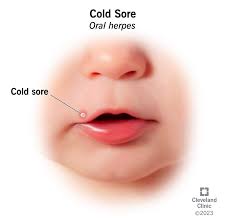 Image result for Oral herpes roof of mouth