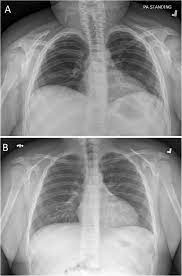 Shrinking Lung Syndrome Treated With Rituximab In Pediatric Systemic Lupus Erythematosus A Case Report And Review Of The Literature Pediatric Rheumatology Full Text