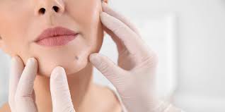 Facial Mole Removal | Dermatology Associates of Plymouth Meeting