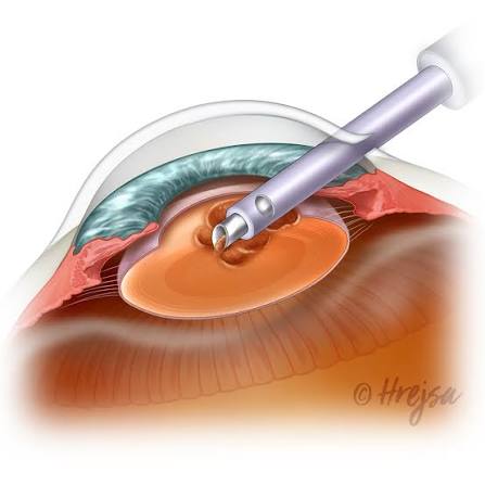 Cataract Surgery Recovery: Day-by-Day Guide for a Safe and Smooth Recovery