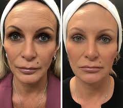 What is botulinum toxin type a? Botox Cosmetic Derma Spa Inc