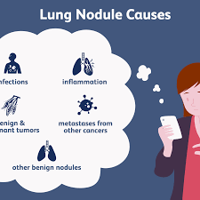 What Does Having A Nodule On The Lung Mean