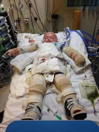 Baby Boy So Severely Burned After Slipping Into Boiling Bath His Skin Fell Off Mirror Online