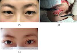 Case 1: (A) A 28-year-old woman with severe puffy upper eyelid; the...