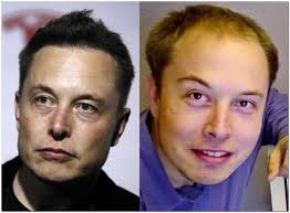 Has Elon Musk Had Cosmetic Work Or Plastic Surgery Quora Plastische Chirurgie Haartransplantation Dermatologie