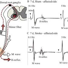 It is named after neurologist johann hoffmann. The Rdd Of The H Reflex A An Illustration Of The H Reflex In The Download Scientific Diagram