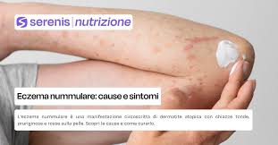 Image result for Eczema nummulare