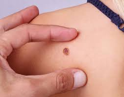 Merkel cell carcinoma forms on or just beneath the skin. Merkel Cell Carcinoma Causes Symptoms And Treatment
