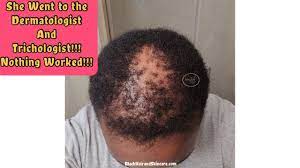 Doctor Diagnosed With Ccca Alopecia Went To See A Dermatologist Trichologist Nothing Worked Until Youtube Alopecia Dermatologist Alopecia Hairstyles