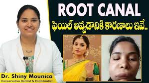 Root Canal ఫెయిల్