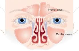 Sinus Infection Sinusitis Cleveland Clinic