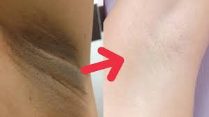 Cara menghilangkan ketiak yang hitam secara alami di antaranya adalah sebagai berikut. Cara Memutihkan Ketiak Dan Sel4ngk4ngan Youtube