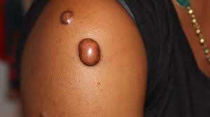 A cherry angioma is a common skin growth that can appear on any part of your body. What Is A Cherry Angioma Causes Treatment And Removal