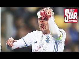 See stats, transfers, rumours, suspensions, injuries and more on domagoj vida here. Dynamo Kiev Star Domagoj Vida Suffers Horror Injury Youtube