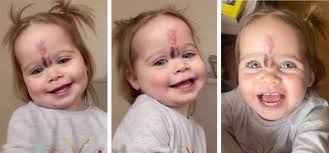 We Got Stares'', Parents Choose to Remove Baby Girl's Rare Birthmark to  Avoid Rude Reactions
