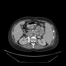 Ovarian Vein Thrombosis Clinical Radiology