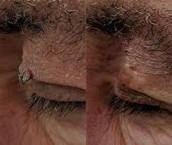 Image result for Skin Tag