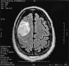 The cancer has reached the lymph. Testicular Cancer Metastatic Exclusively To The Brain And Spleen Urology