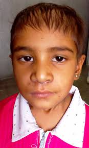 Primary alveolar rhabdomyosarcoma: a horrendous presentation with  miraculous remission