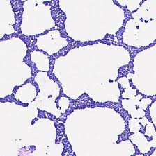 Image result for Staphylococcus Saprophyticus