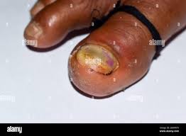 Image result for Paronychia feet