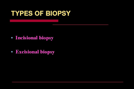 This type of biopsy uses a suction device to collect a tissue sample through a specially designed needle. Biopsy Introduction The Famous Theme That The Best