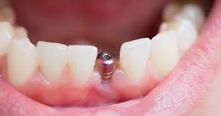 Medicare does not cover any oral care. Dental Implants Restorative Dentistry Island Daily Dental Care
